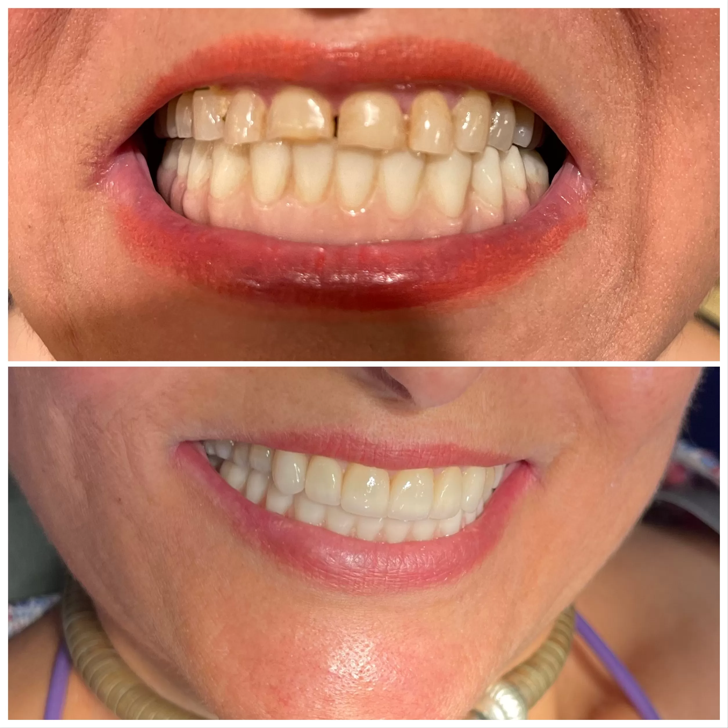 Before and After Teeth client picture