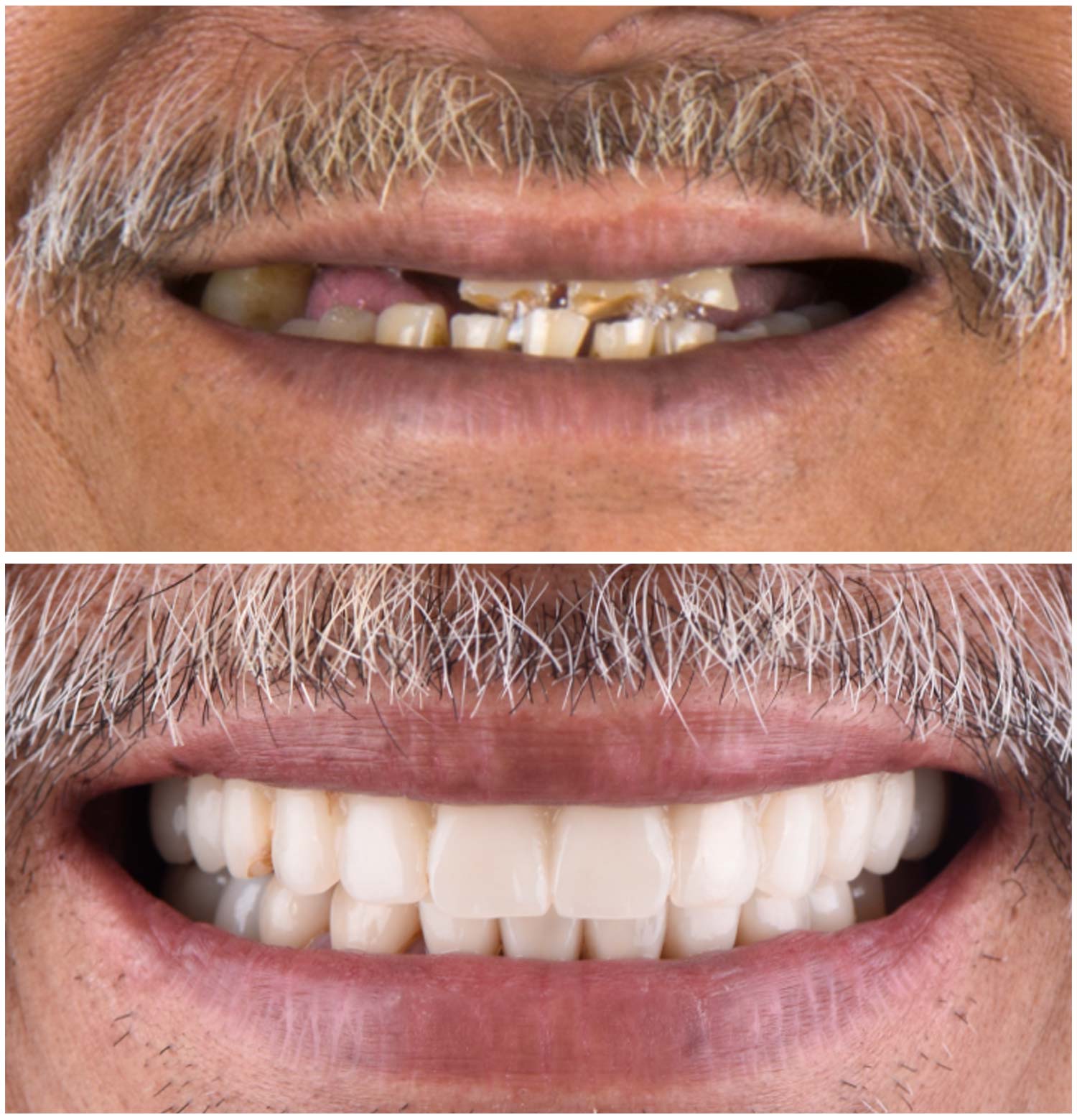 All-on-4 Procedure Before & After Photo