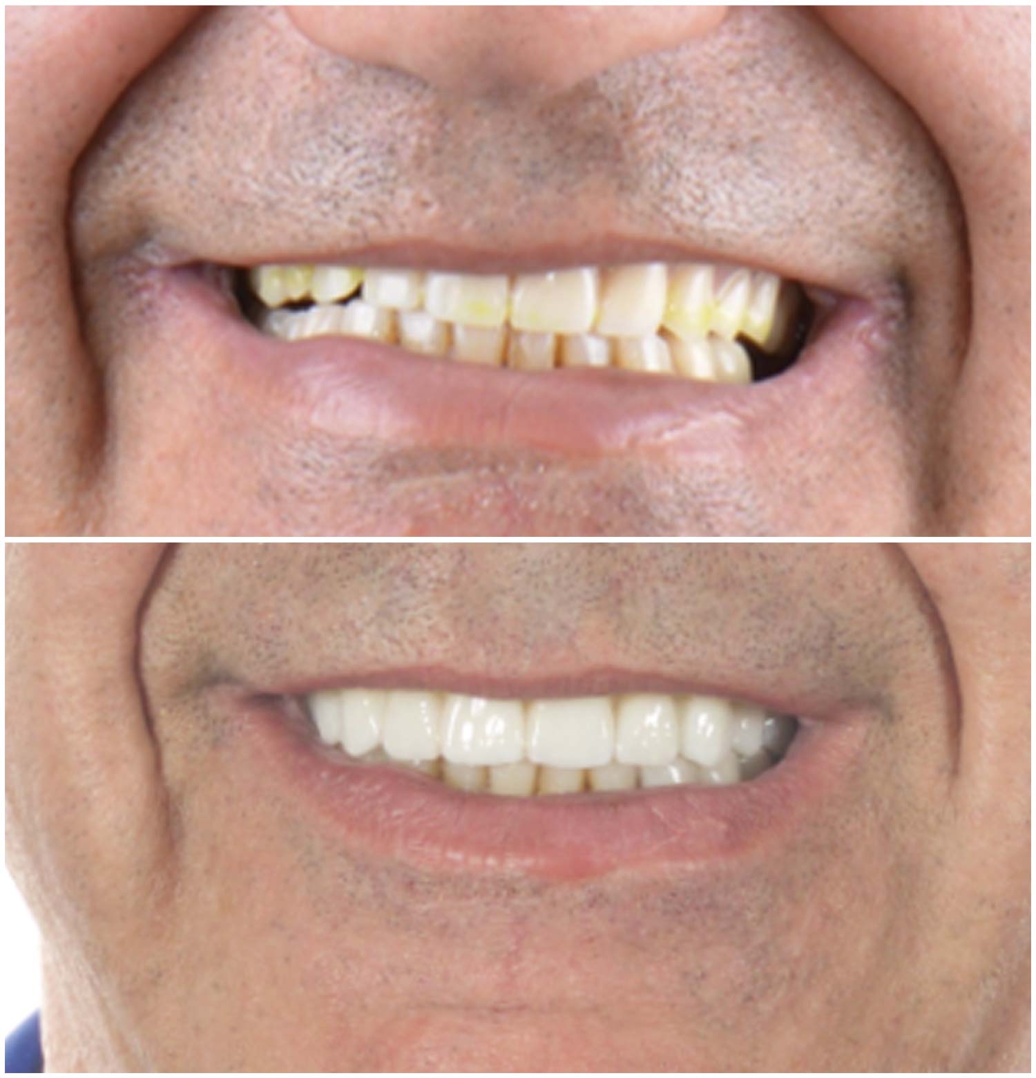 All-on-4 Procedure Before & After Photo