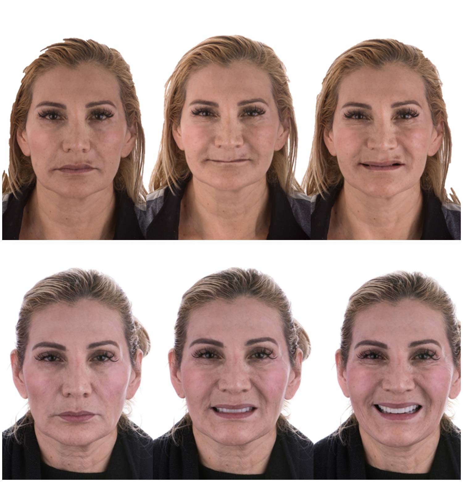 All-on-4 Procedure Before & After Photo