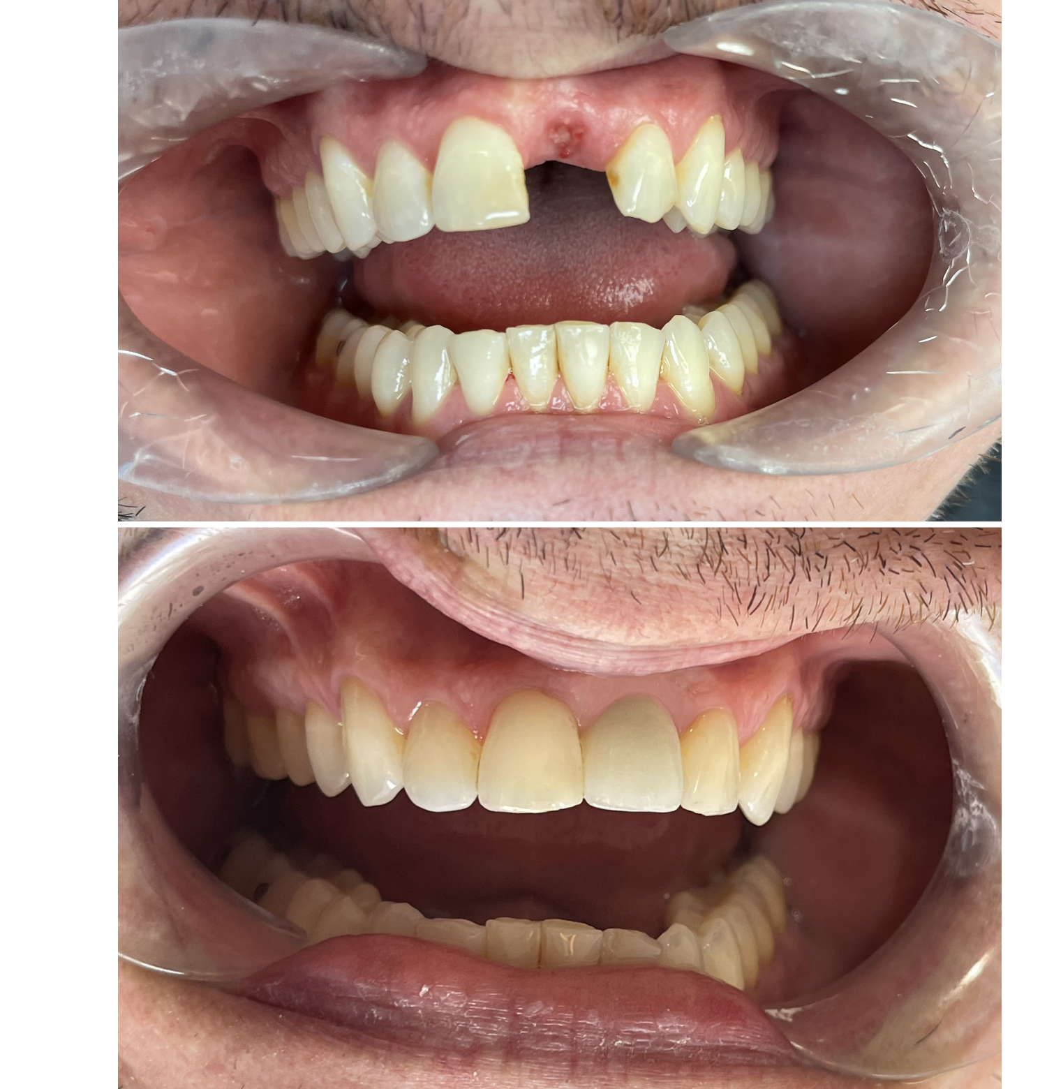 Front Implant and Crown
